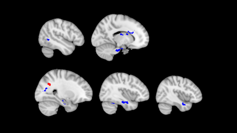 Black and white image depicting five different scans of a brain. 